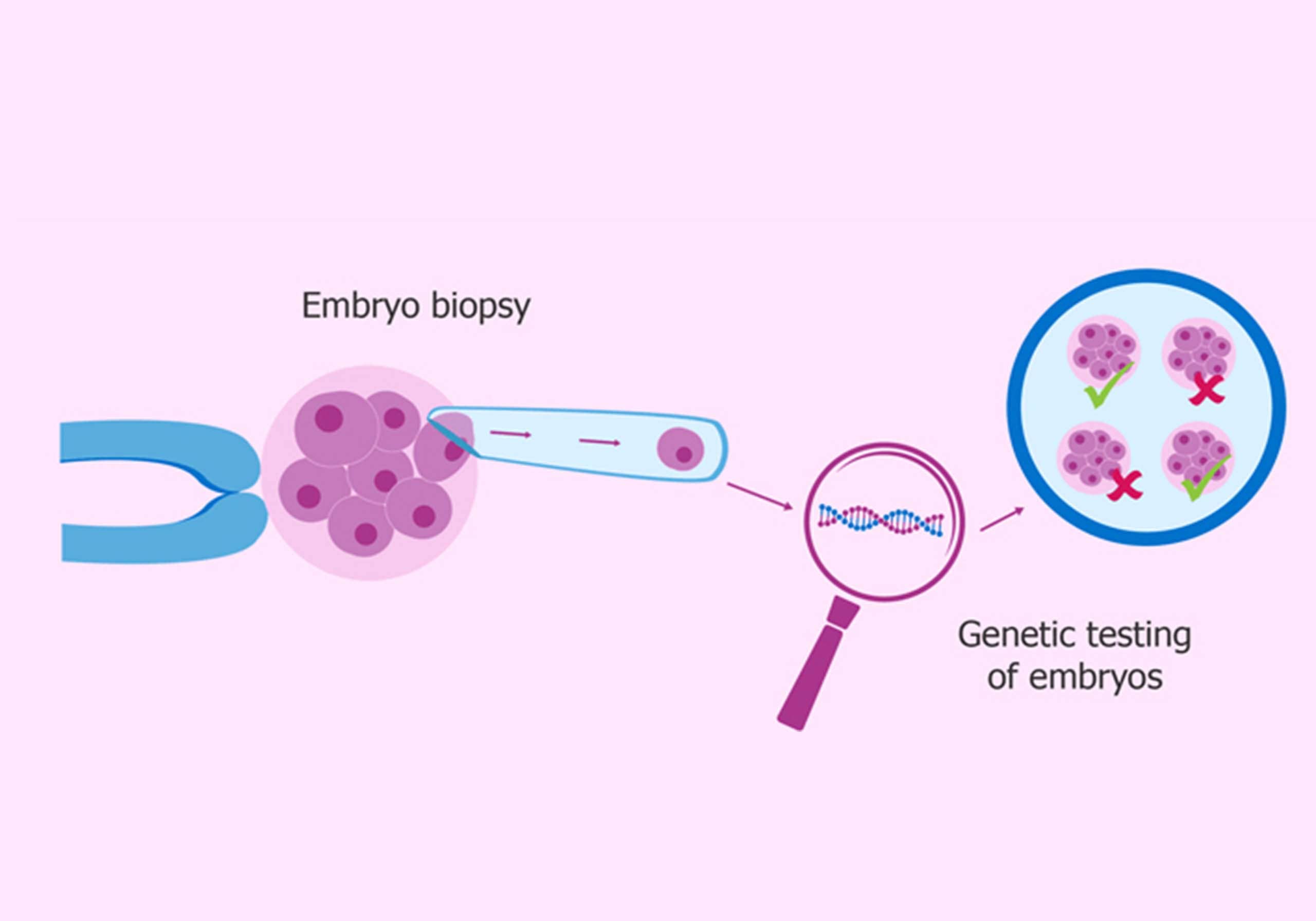 [胚胎活检和PGT]